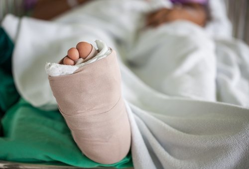 close up on foot covered in cast, person lying in hospital bed
