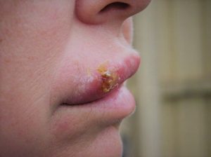 Woman with herpes on her mouth