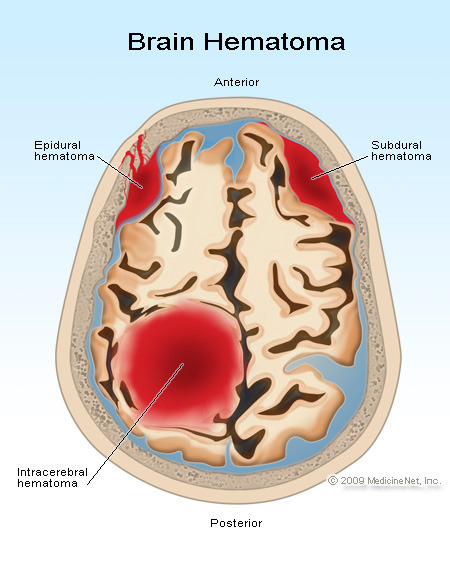 Sección transversal del cerebro mostrando hematoma