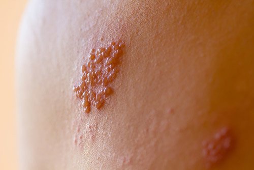 shingles on skin