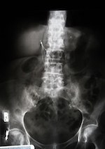 x-ray