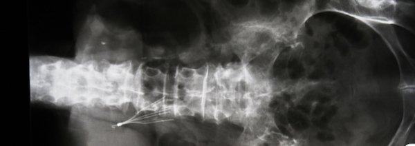 ivc filter xray