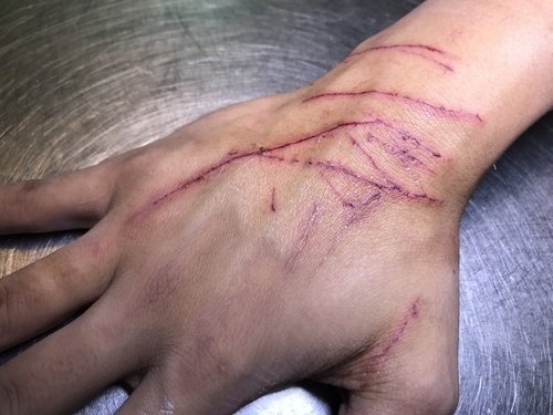 mano humana cubierta de arañazos de gato