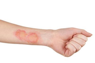 a person with burn marks on arm