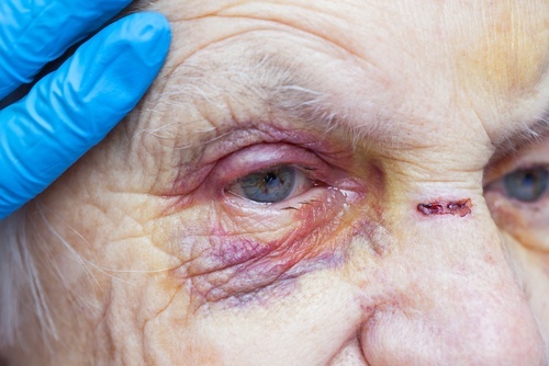 Mujer mayor con moretones en la cara y una mano con un guante de látex examinándola suavemente