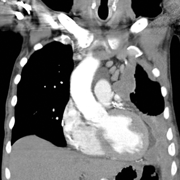 Rayos X mostrando mesotelio en los pulmones