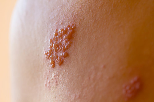 shingles