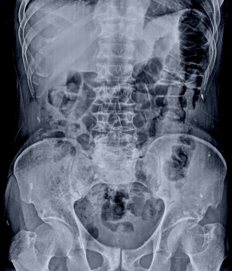 X-ray showing perforated gastrointestinal organs.