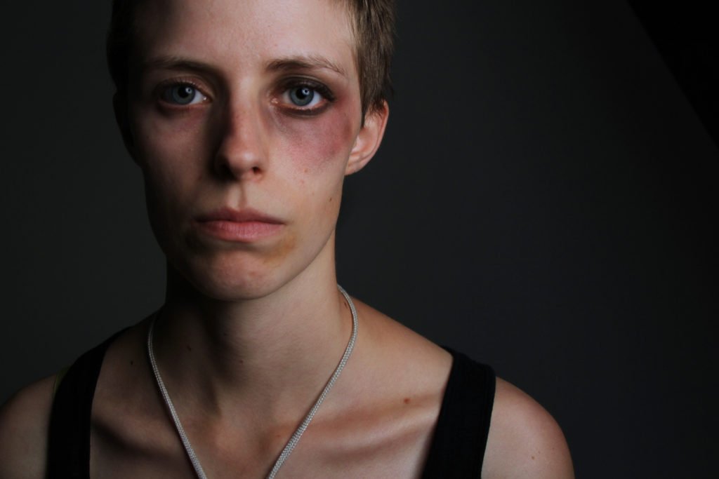 Woman with black eye from gender-based hate crime