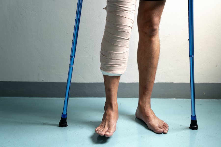 Closeup of battery victim in cast and with a cane