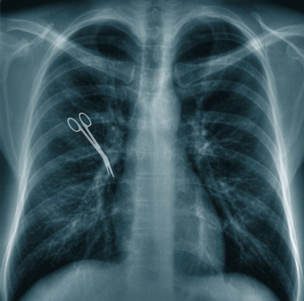 Una radiografía de unas tijeras de un cirujano en el área del pecho de un paciente.