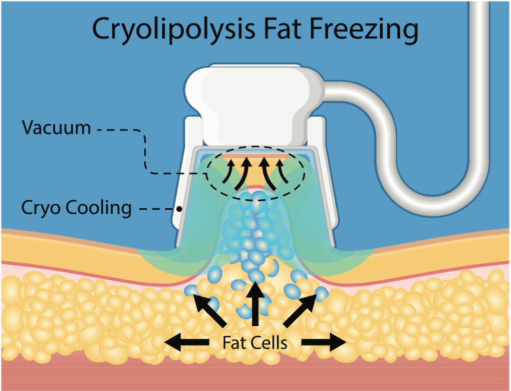 CoolSculpting® Lawsuits for PAH Victims